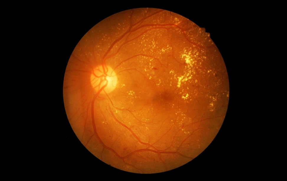 Lasik Eye Surgery
